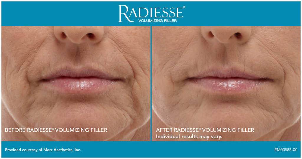 RADIESSE Front Smile Lines 2