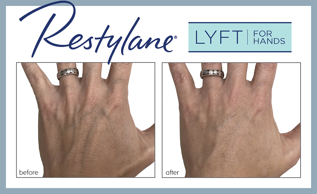 Restylane Lyft hands 1