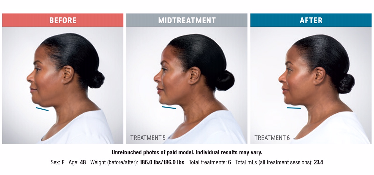 kybella3