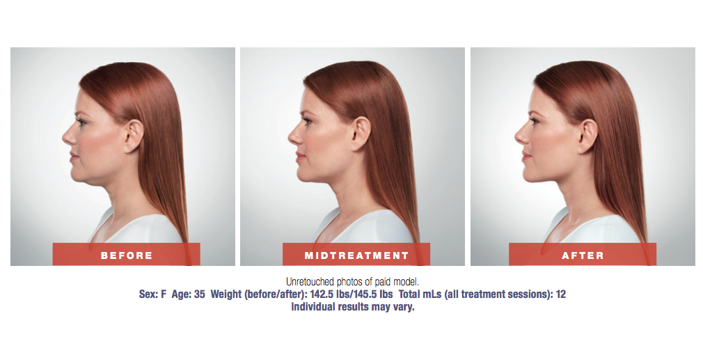 kybella4